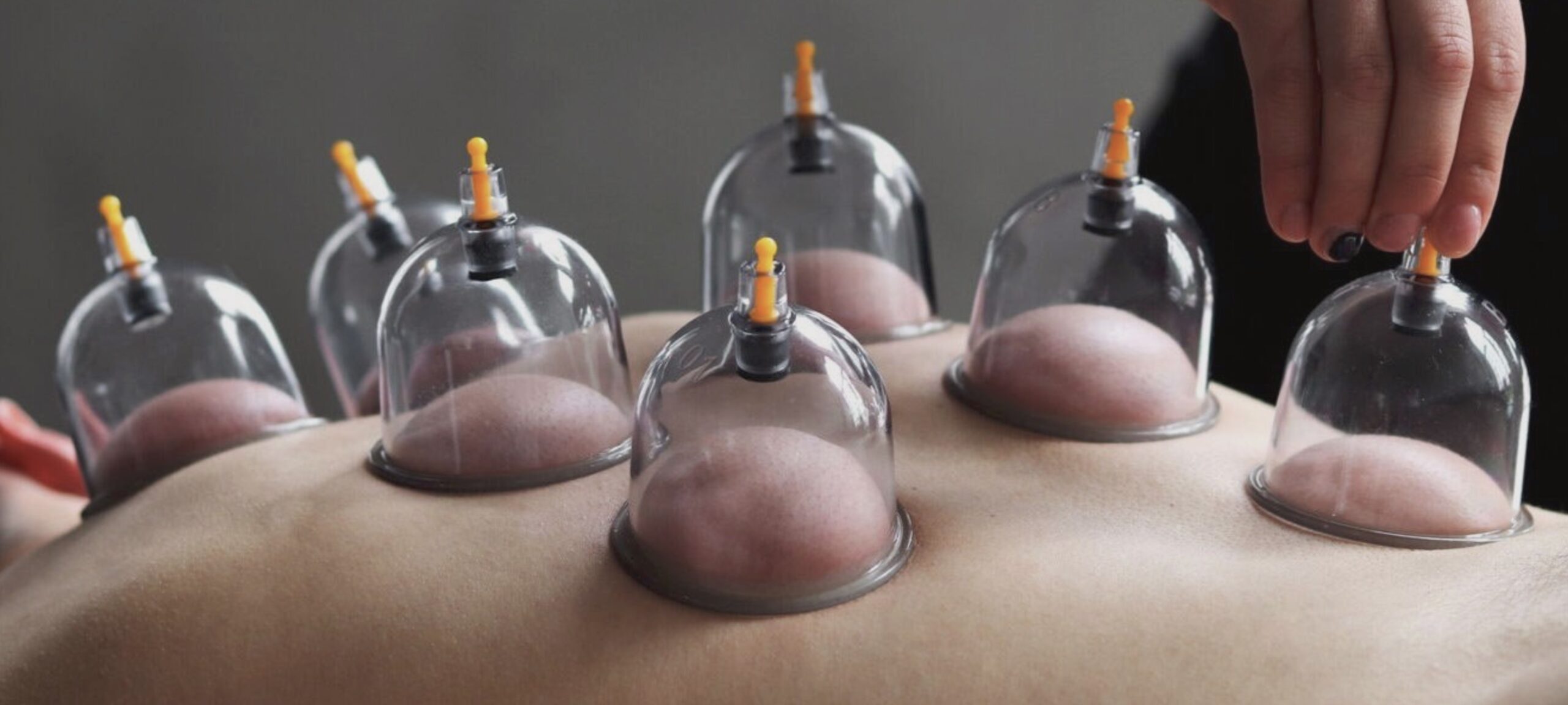 Cupping therapy in Koh phangan 